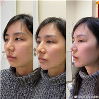李嘉伦面部整形