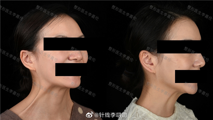 李叨叨医生