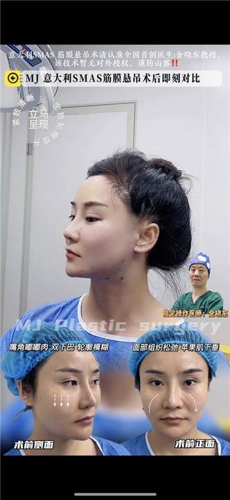 上海筋膜悬吊术