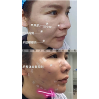 意大利筋膜悬吊术