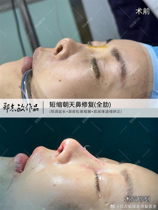 郑志敏医生全肋软骨修复挛缩鼻案例