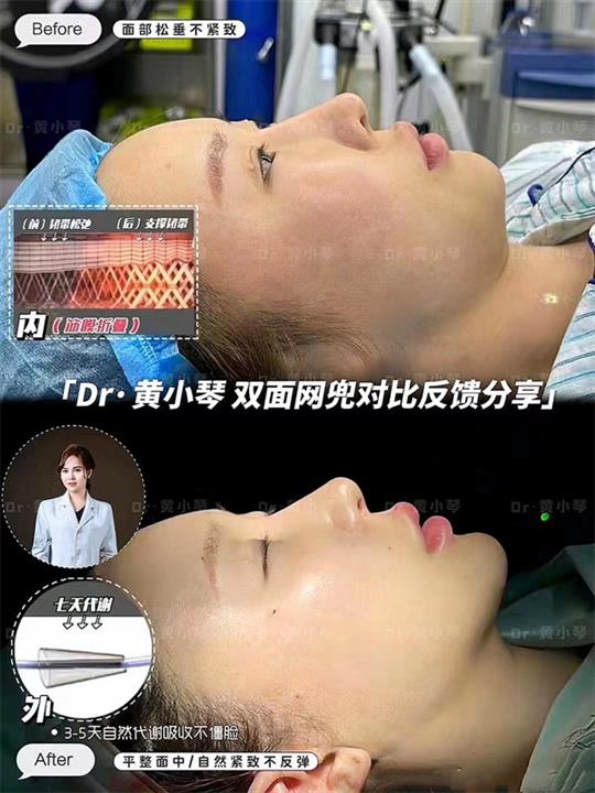 双面网兜对比图