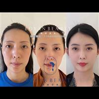 广州印第安纹剥离