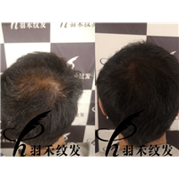 羽禾纹发前后案例 