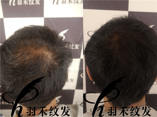 羽禾纹发前后案例 