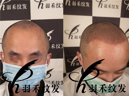 羽禾纹发前后案例