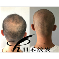成都纹发案例 