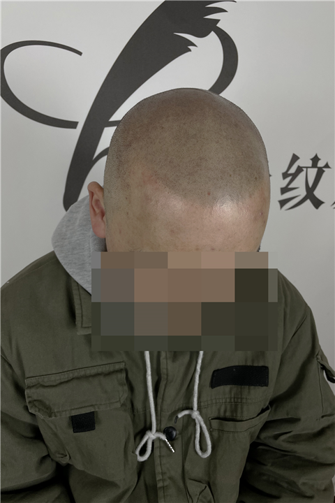 成都纹发对自身毛囊有哪些影响