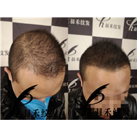 羽禾纹发前后案例
