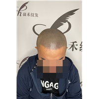 羽禾纹发前后案例2021