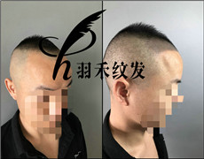 成都纹发案例