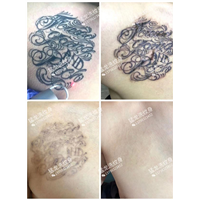 东莞洗纹身