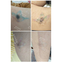 东莞洗纹身哪里好东莞洗彩色纹身