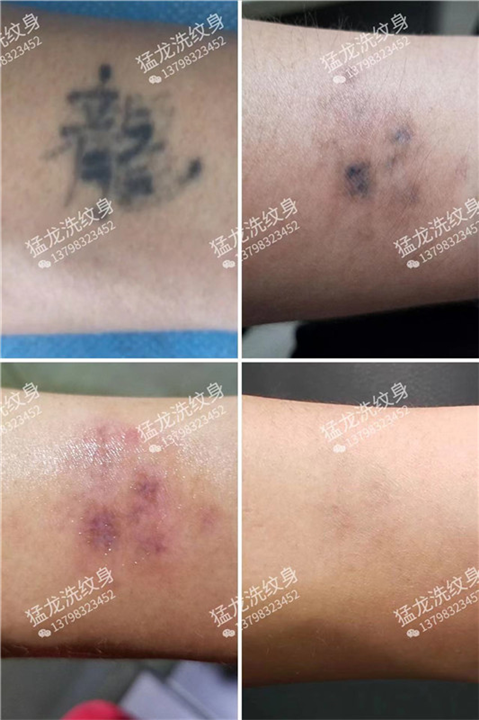 东莞长安洗纹身电光虎门洗纹身东莞洗纹身