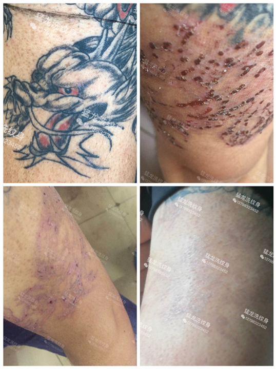 东莞石龙洗纹身哪里效果好
