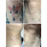 东莞洗眼线热线