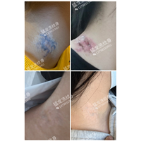 东莞洗纹身咨询