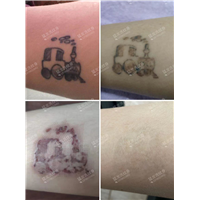东莞洗纹身哪里好东莞洗纹身哪里专业