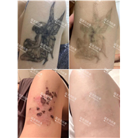 东莞洗眼线东莞洗唇线