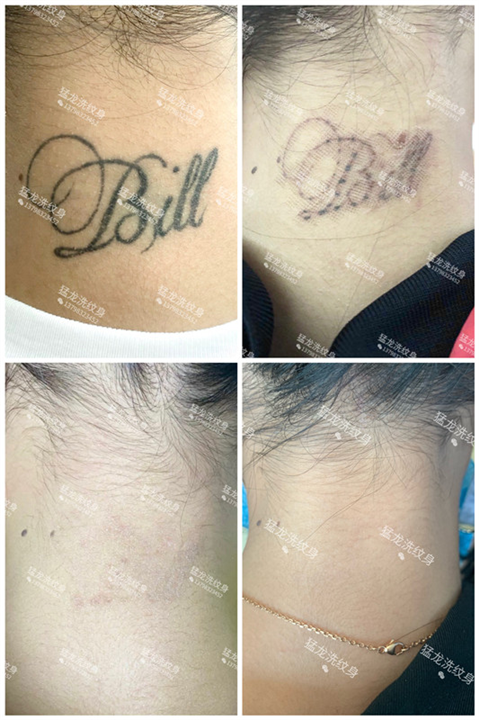 东莞洗彩色纹身哪里好东莞洗纹身
