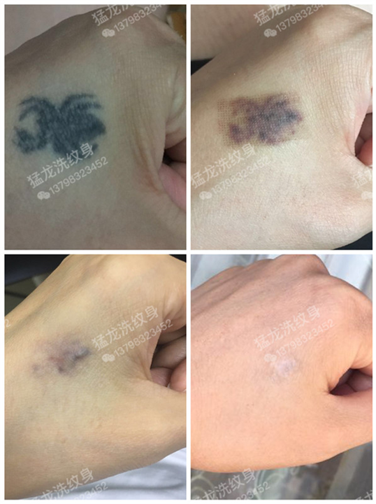 东莞洗彩色纹身东莞洗唇线