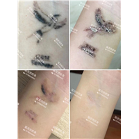 东莞万江洗纹身哪里效果好