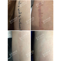 东莞洗纹身定点机构洗纹身效果有保障