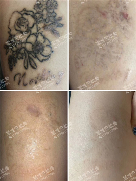 东莞洗唇线东莞洗纹身找谁好