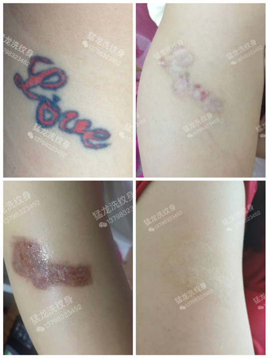 东莞洗彩色纹身东莞洗胎记