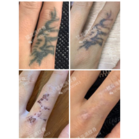 东莞樟木头洗纹身哪里好不留疤痕