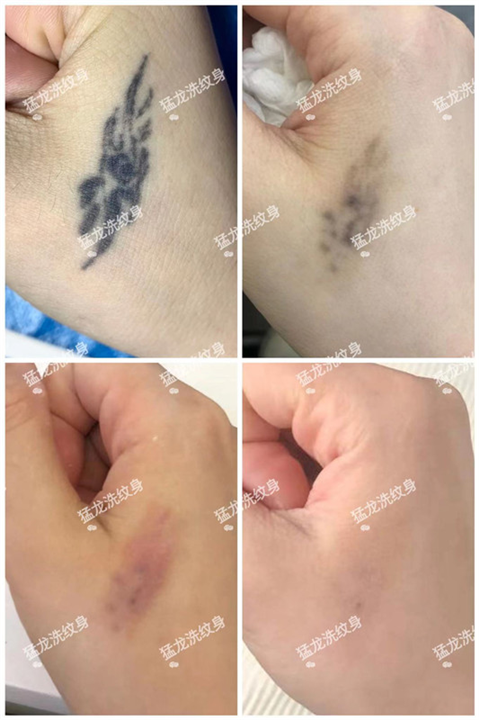 东莞洗纹身专业洗纹身品牌
