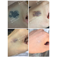 东莞洗彩色纹身东莞洗唇线