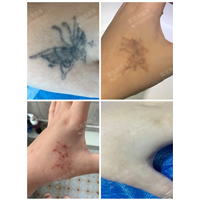 东莞洗纹身东莞洗眉