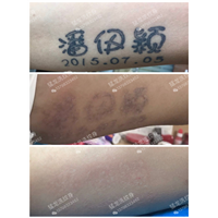 东莞洗纹身