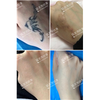 东莞洗纹身行业专注洗纹身20年