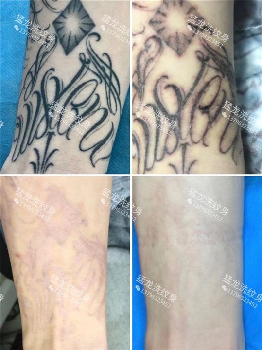 东莞洗纹身找谁好东莞洗纹身