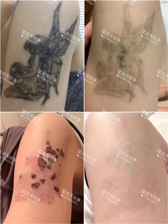 东莞洗眼线东莞洗唇线