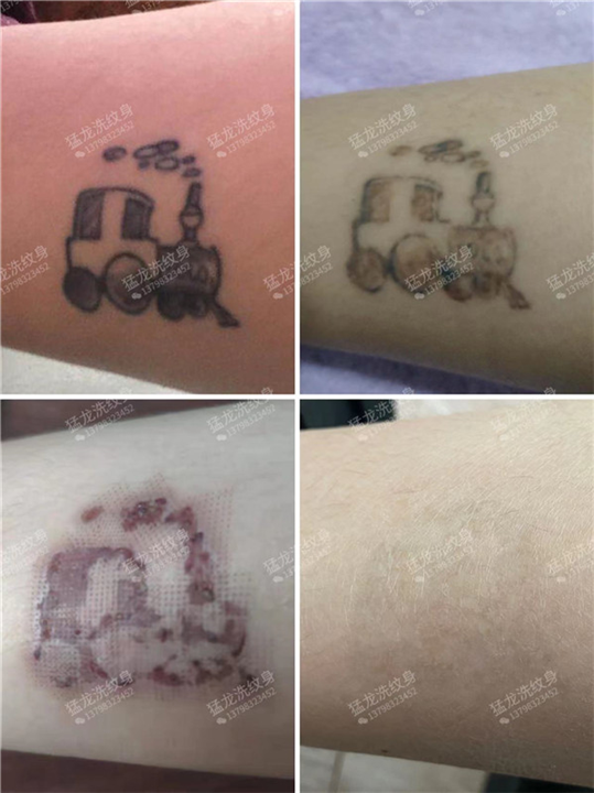 东莞洗纹身哪里好东莞洗纹身哪里专业