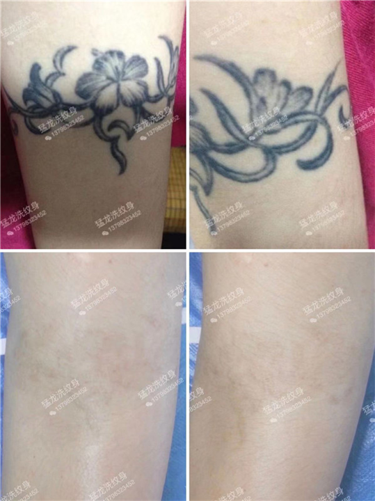 东莞哪里可以洗纹身东莞专业洗纹身