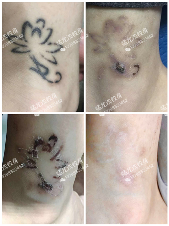 东莞石排洗纹身哪里好价钱合理