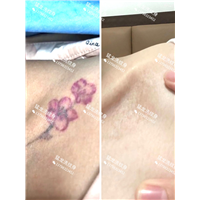 东莞洗眼线东莞猛龙洗纹身