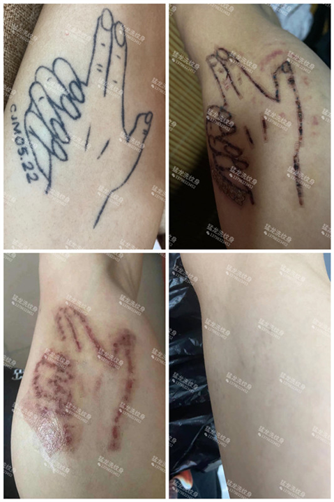 东莞激光洗纹身东莞洗纹身