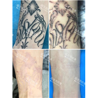 东莞洗纹身找谁好东莞洗纹身
