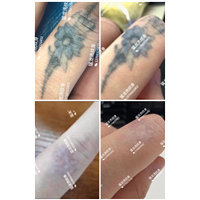 东莞洗纹身哪里效果好