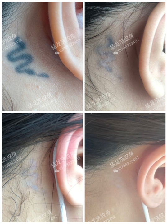 广州洗纹身广州洗眼线