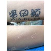 广州洗纹身哪里好不留疤痕