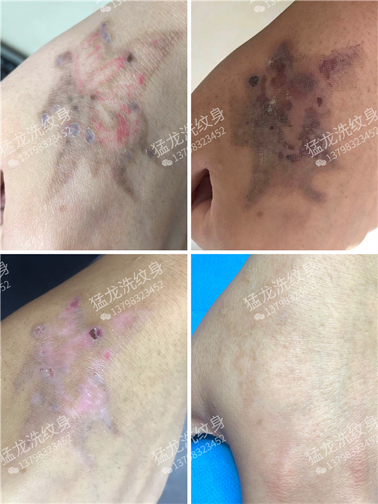 广州哪里可以洗纹身