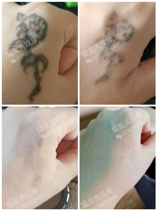 广州洗纹身