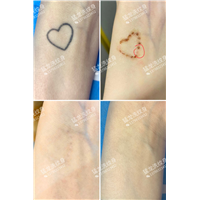 广州洗纹身广州激光洗纹身