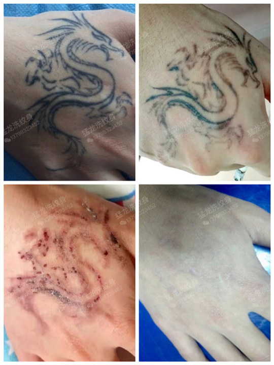 广州洗纹身
